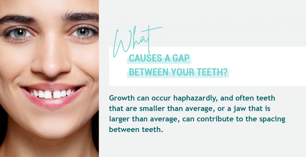 My Teeth Are Straight but Have Gaps: Can I Use Aligners?