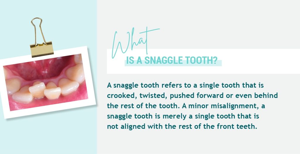 Fixing Snaggle Tooth With Invisible Aligners Ez Smile 